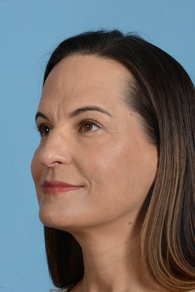 Facial Augmentation Before & After Gallery - Patient 275142 - Image 12