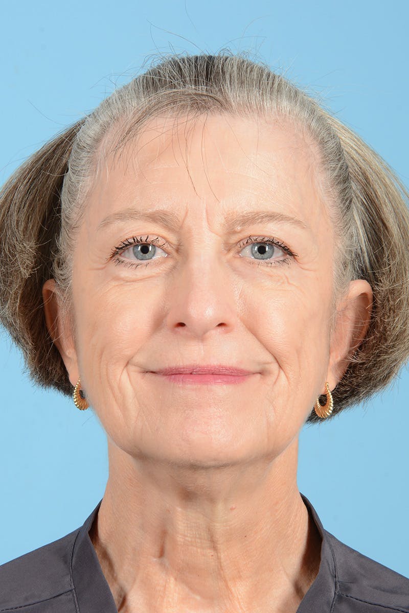 Endoscopic Brow Lift Before & After Gallery - Patient 905420 - Image 3