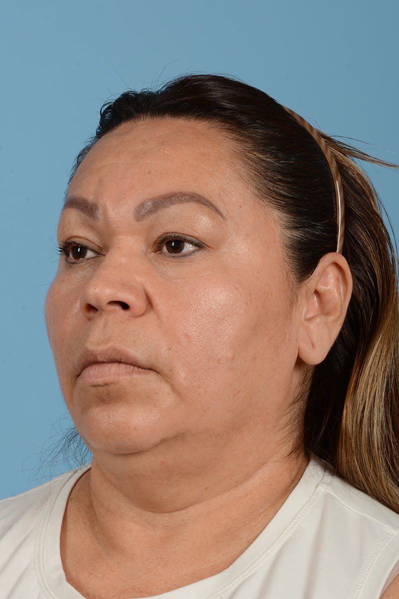 Endoscopic Brow Lift Before & After Gallery - Patient 314786 - Image 9