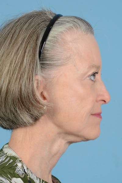 Endoscopic Brow Lift Before & After Gallery - Patient 905420 - Image 10