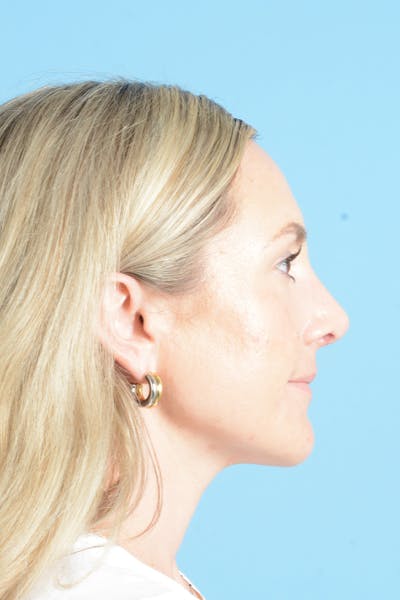 Rhinoplasty Before & After Gallery - Patient 172246 - Image 10