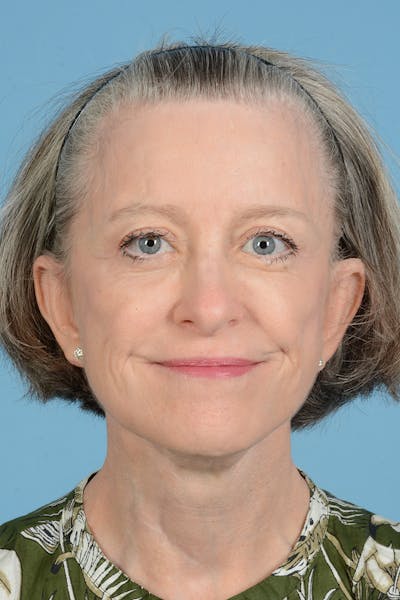 Endoscopic Brow Lift Before & After Gallery - Patient 905420 - Image 4