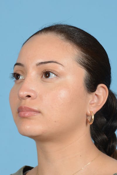 Rhinoplasty Before & After Gallery - Patient 175728 - Image 8