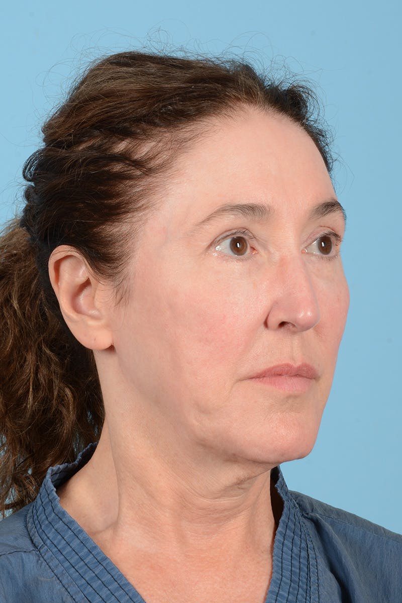 Facelift Before & After Gallery - Patient 339885 - Image 5