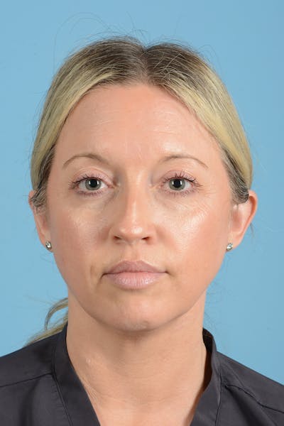 Rhinoplasty Before & After Gallery - Patient 353266 - Image 1