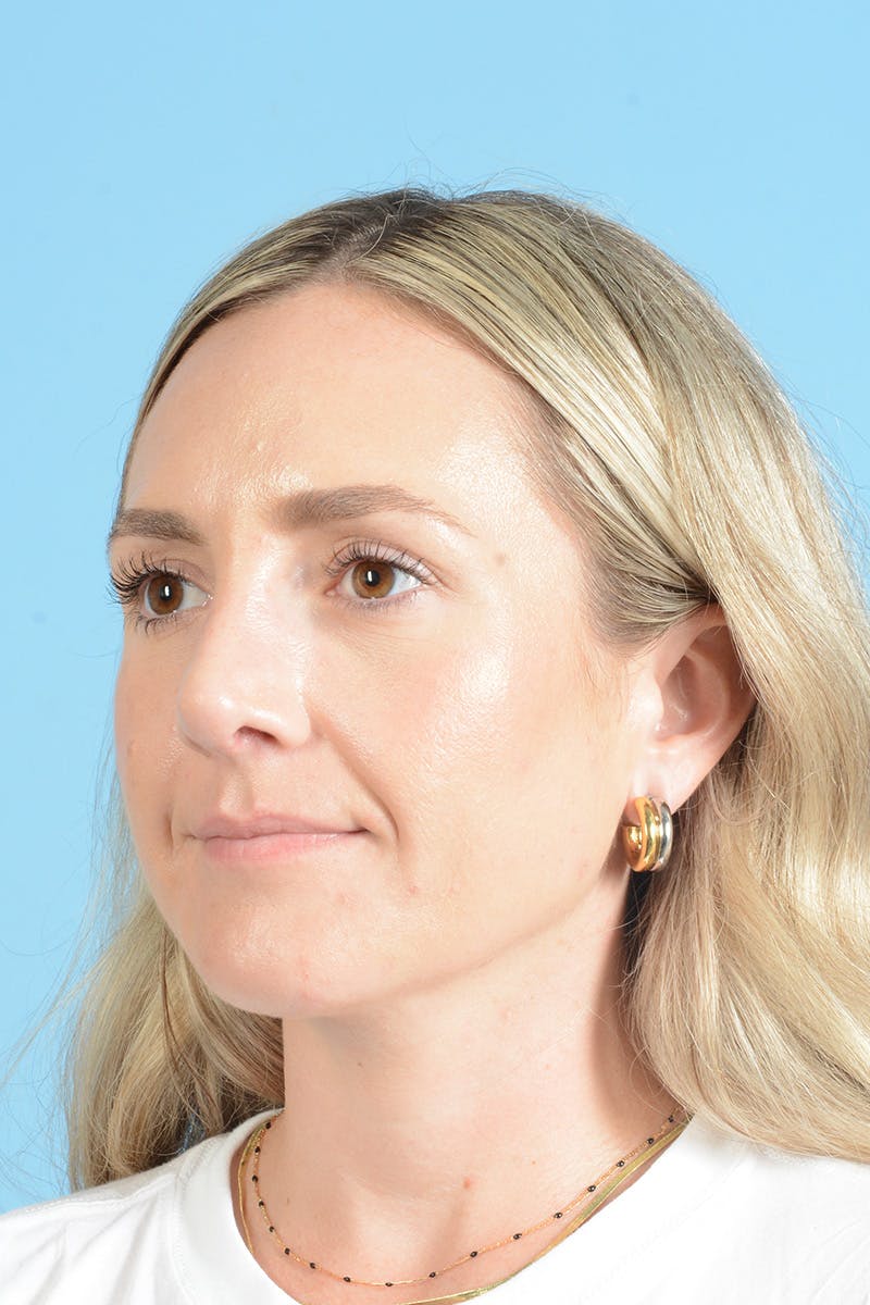 Rhinoplasty Before & After Gallery - Patient 172246 - Image 12