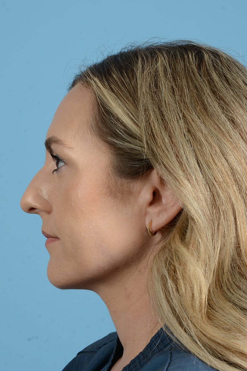 Rhinoplasty Before & After Gallery - Patient 172246 - Image 13