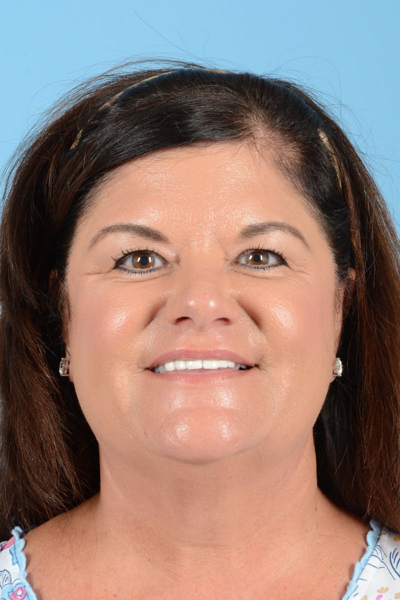 Facelift Before & After Gallery - Patient 214856 - Image 3