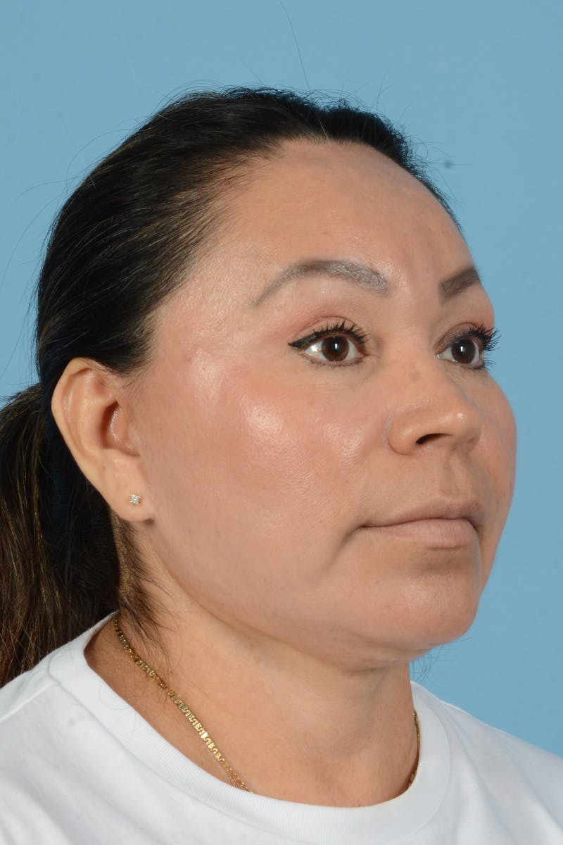 Endoscopic Brow Lift Before & After Gallery - Patient 314786 - Image 6