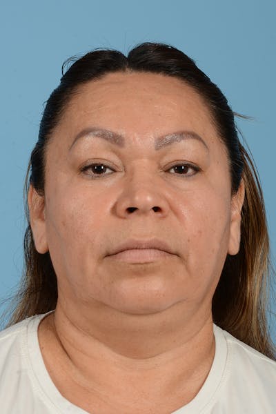 Facial Augmentation Before & After Gallery - Patient 116312 - Image 1