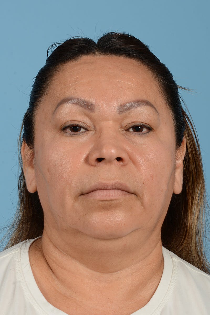 Endoscopic Brow Lift Before & After Gallery - Patient 314786 - Image 1