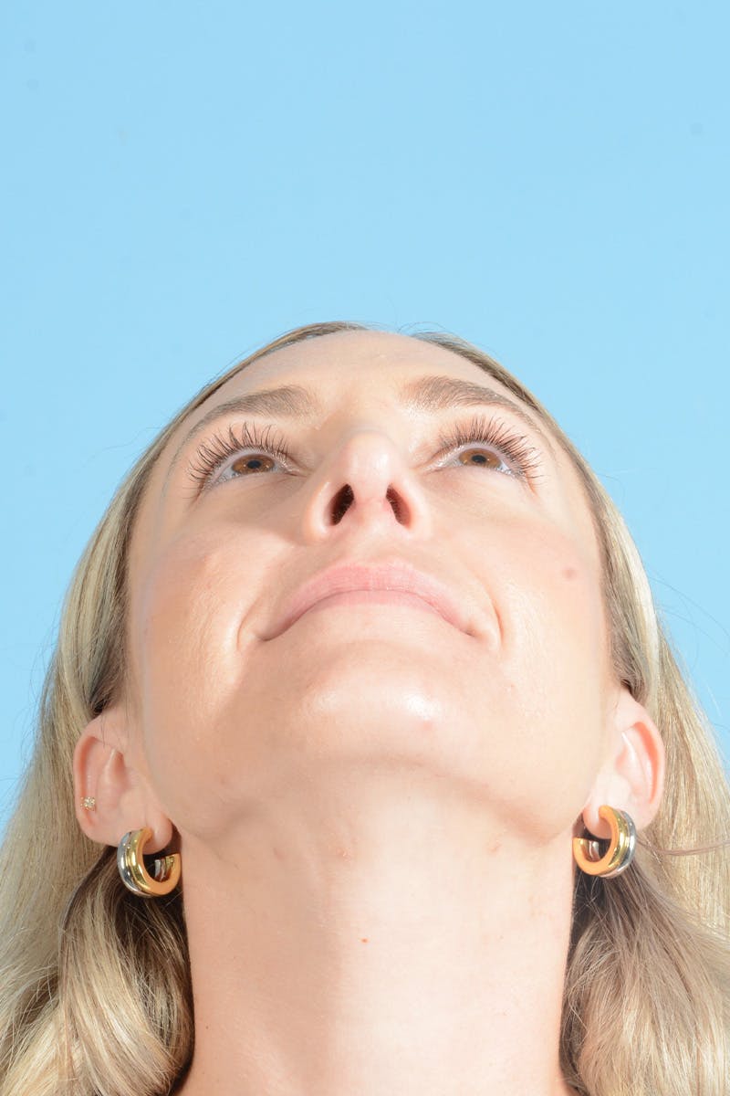 Rhinoplasty Before & After Gallery - Patient 172246 - Image 16