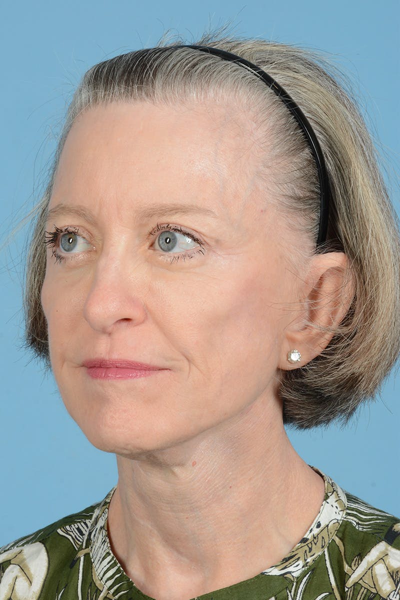 Endoscopic Brow Lift Before & After Gallery - Patient 905420 - Image 12