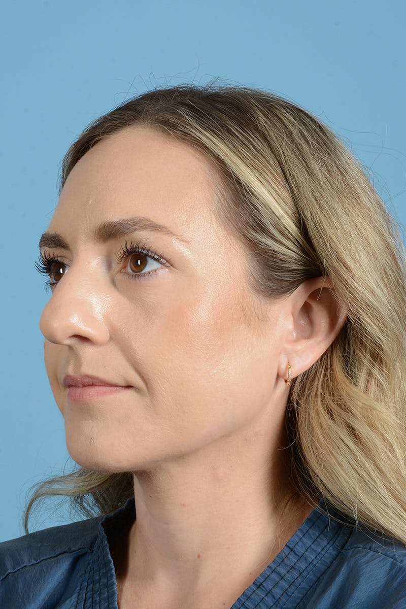 Rhinoplasty Before & After Gallery - Patient 172246 - Image 11