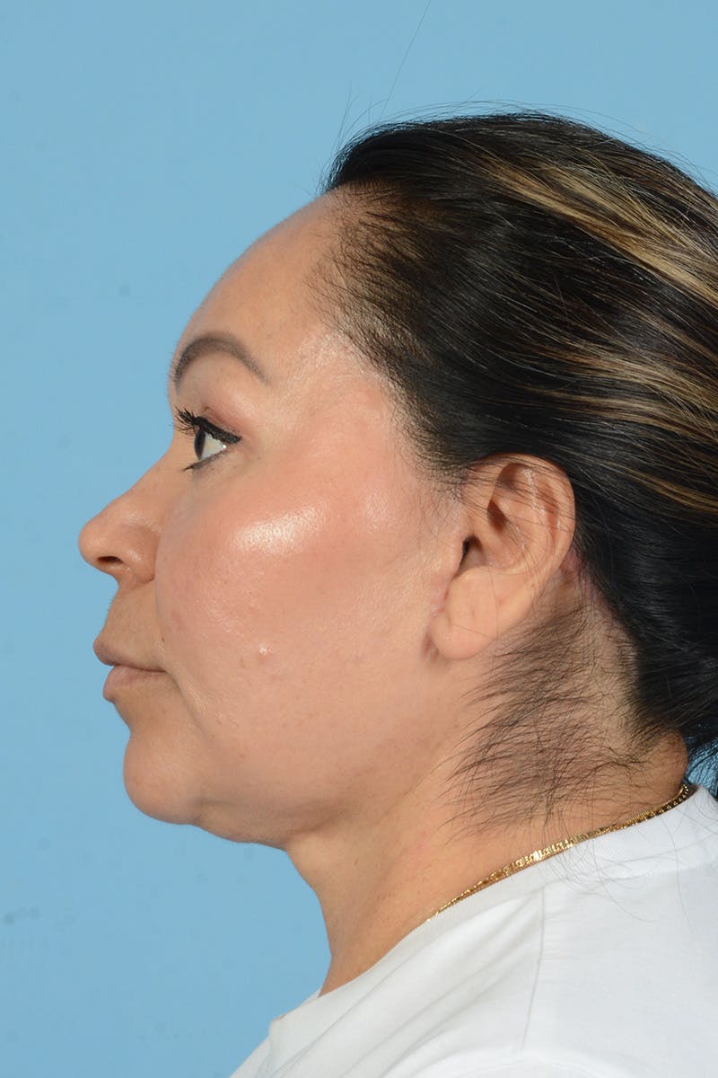 Endoscopic Brow Lift Before & After Gallery - Patient 314786 - Image 12