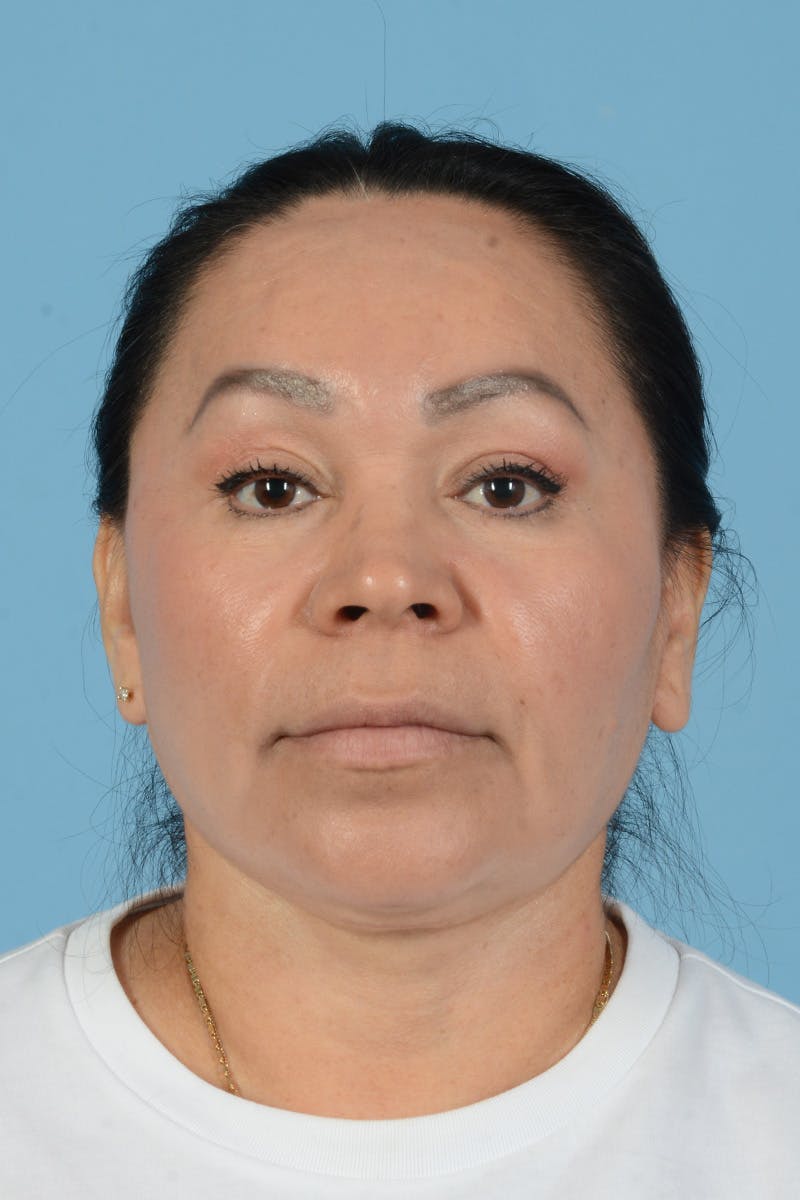 Endoscopic Brow Lift Before & After Gallery - Patient 314786 - Image 2