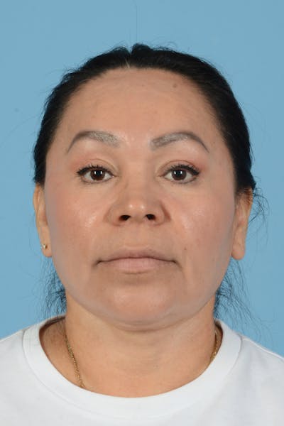 Endoscopic Brow Lift Before & After Gallery - Patient 314786 - Image 2