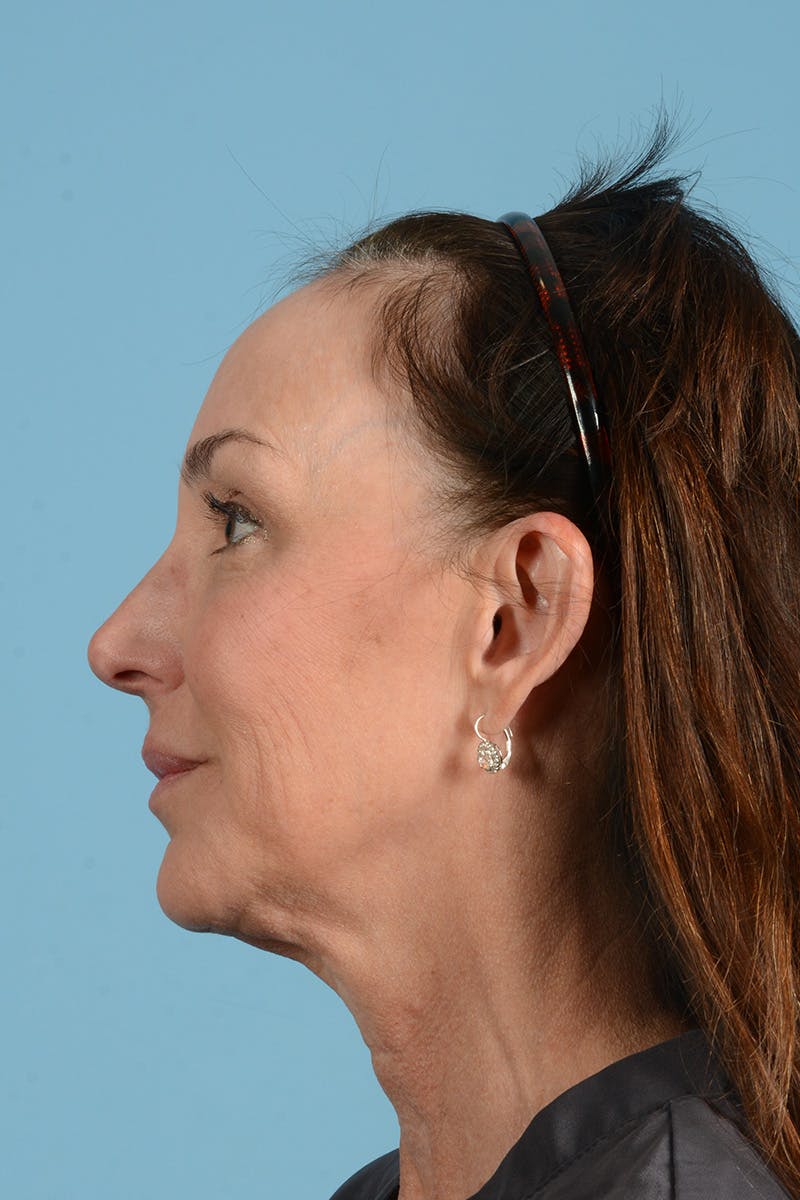 Facial Augmentation Before & After Gallery - Patient 211177 - Image 9
