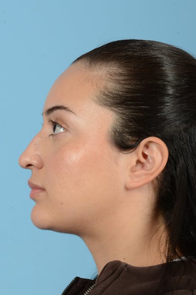 Rhinoplasty Before & After Gallery - Patient 175728 - Image 10