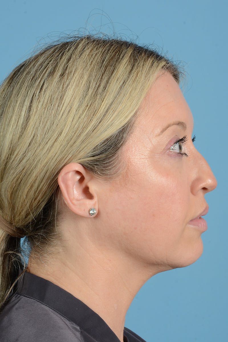 Rhinoplasty Before & After Gallery - Patient 353266 - Image 9