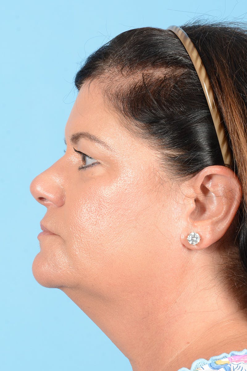 Facelift Before & After Gallery - Patient 214856 - Image 11