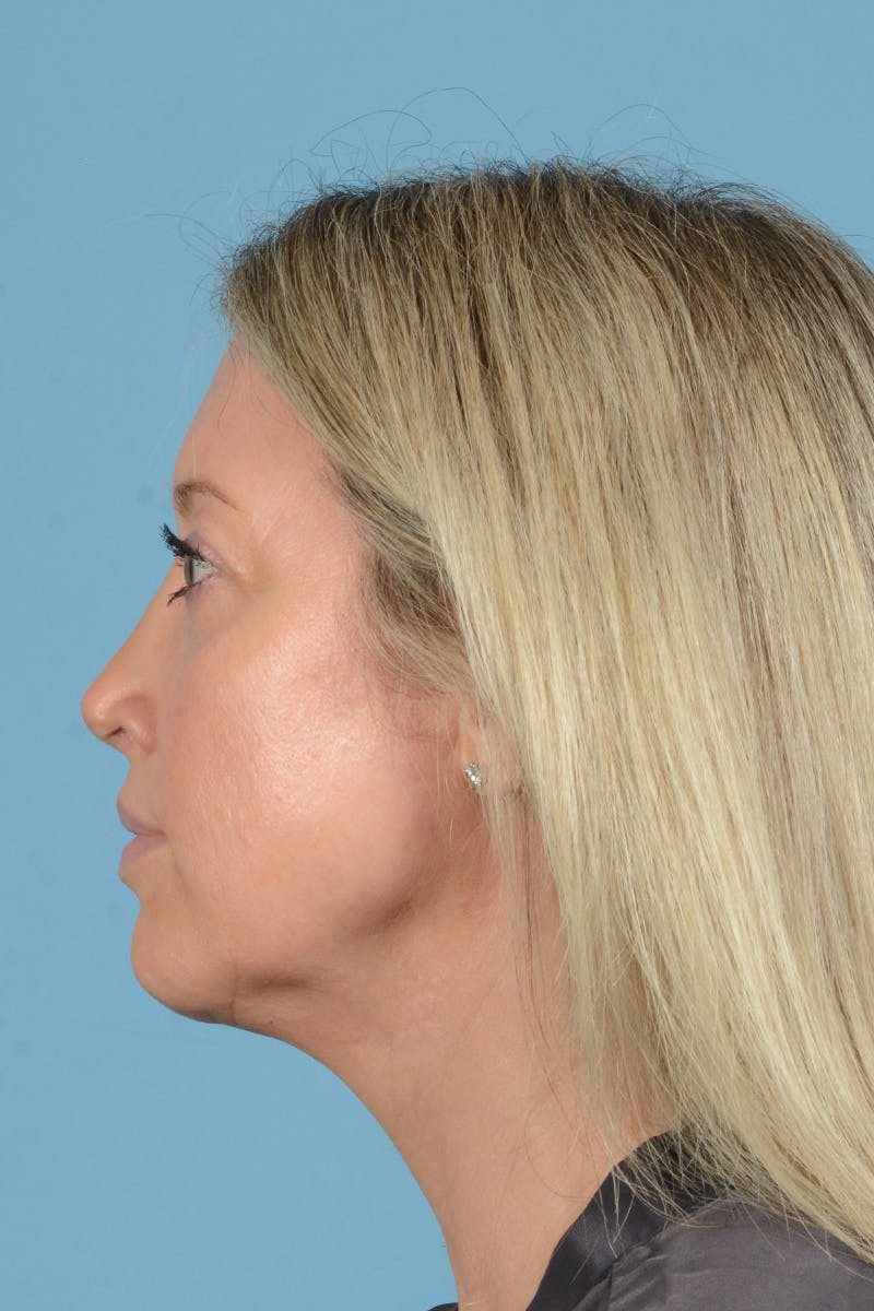 Rhinoplasty Before & After Gallery - Patient 353266 - Image 14