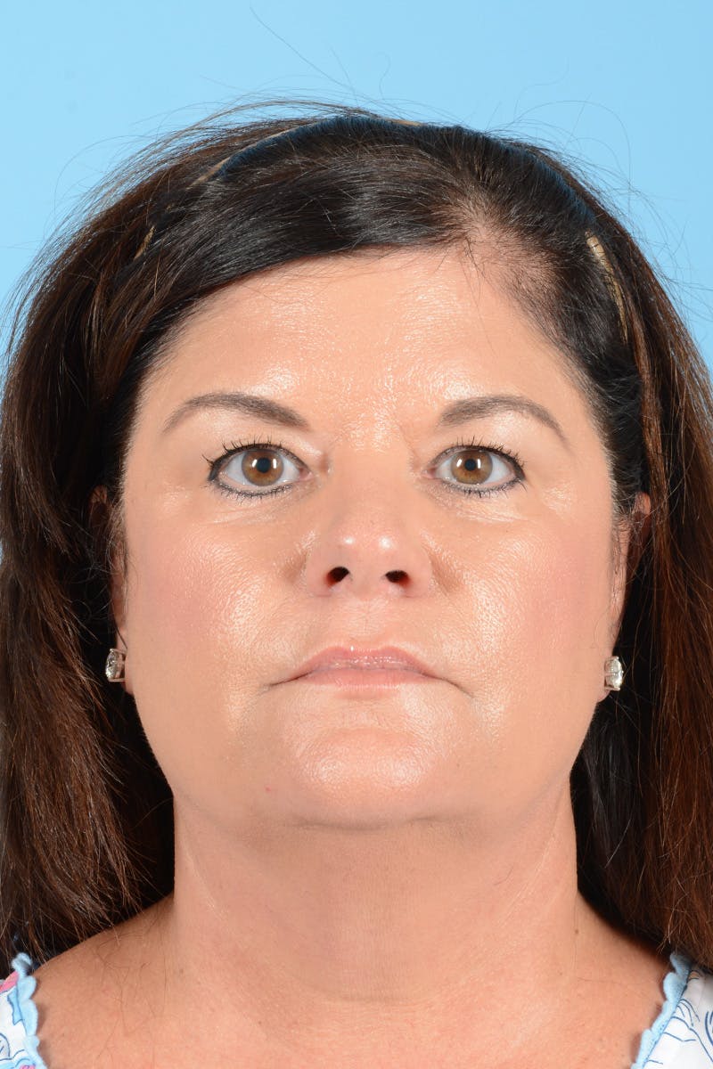 Facelift Before & After Gallery - Patient 214856 - Image 1