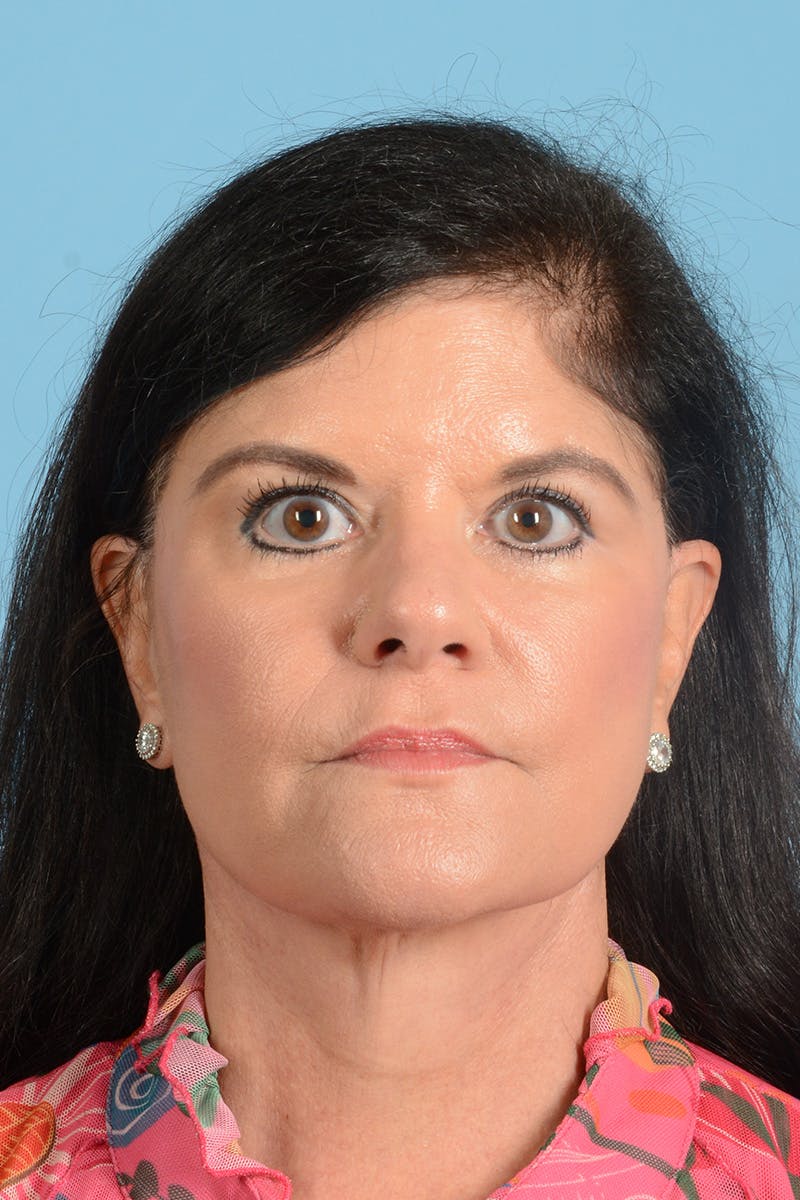Facelift Before & After Gallery - Patient 214856 - Image 2