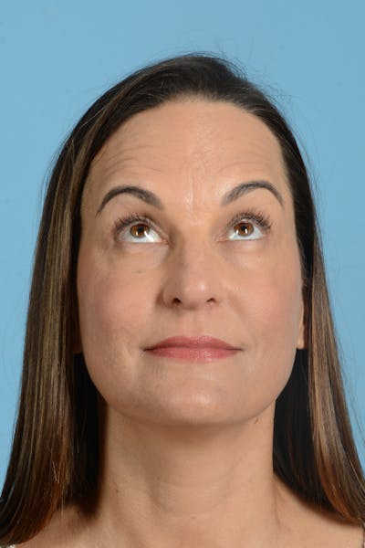 Facial Augmentation Before & After Gallery - Patient 275142 - Image 4