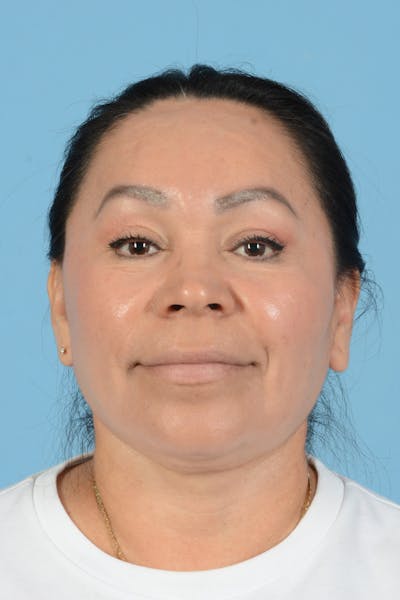 Endoscopic Brow Lift Before & After Gallery - Patient 314786 - Image 4