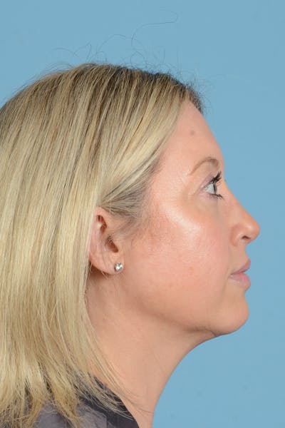 Rhinoplasty Before & After Gallery - Patient 353266 - Image 10