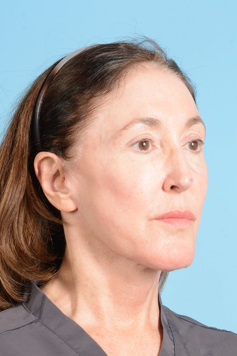 Facelift Before & After Gallery - Patient 339885 - Image 6