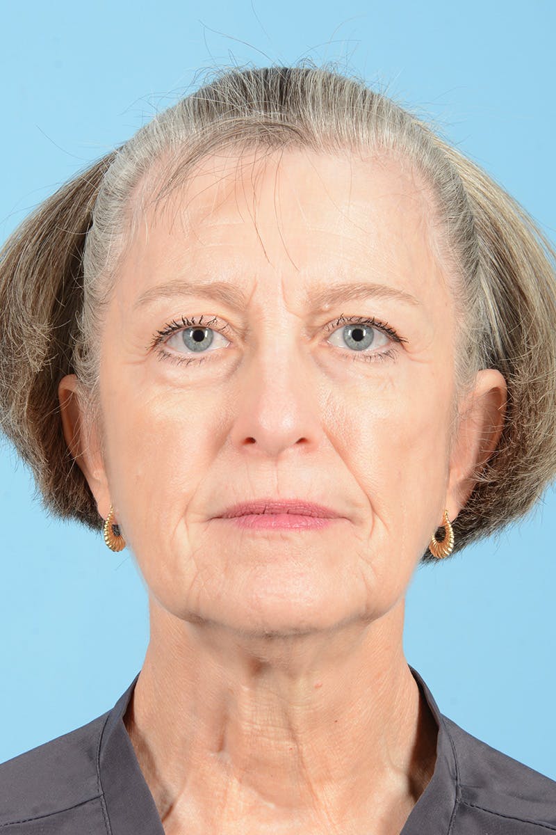 Endoscopic Brow Lift Before & After Gallery - Patient 905420 - Image 1