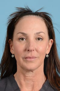 Facelift Before & After Gallery - Patient 275822 - Image 1