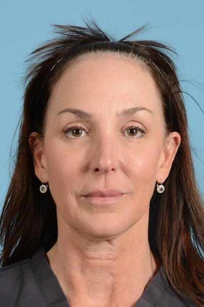 Facelift Before & After Gallery - Patient 275822 - Image 1