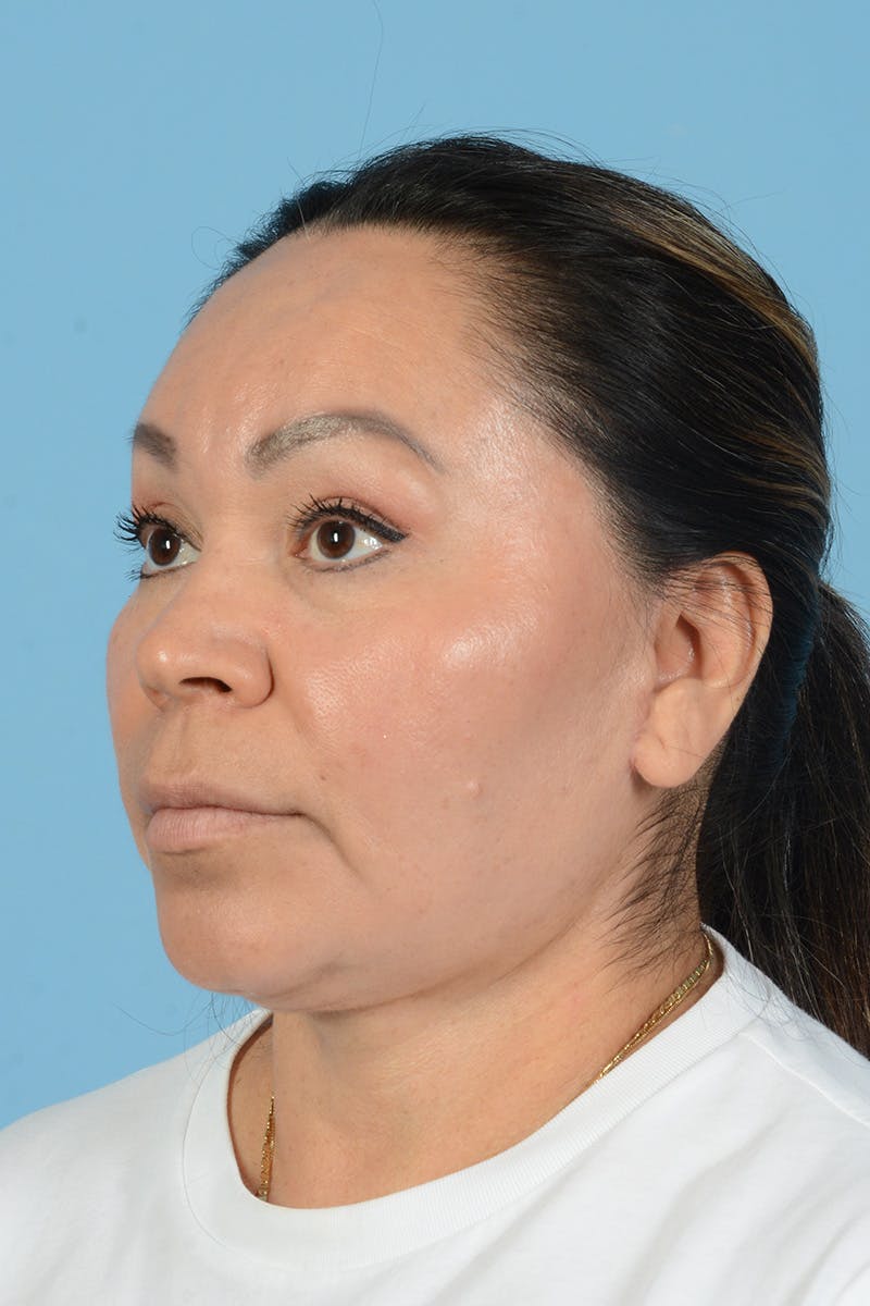 Endoscopic Brow Lift Before & After Gallery - Patient 314786 - Image 10