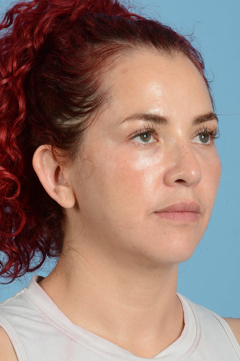 Neck Lift Before & After Gallery - Patient 126947 - Image 3