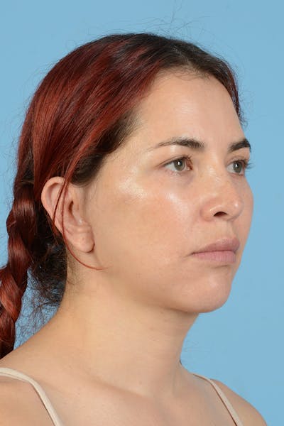Neck Lift Before & After Gallery - Patient 126947 - Image 4