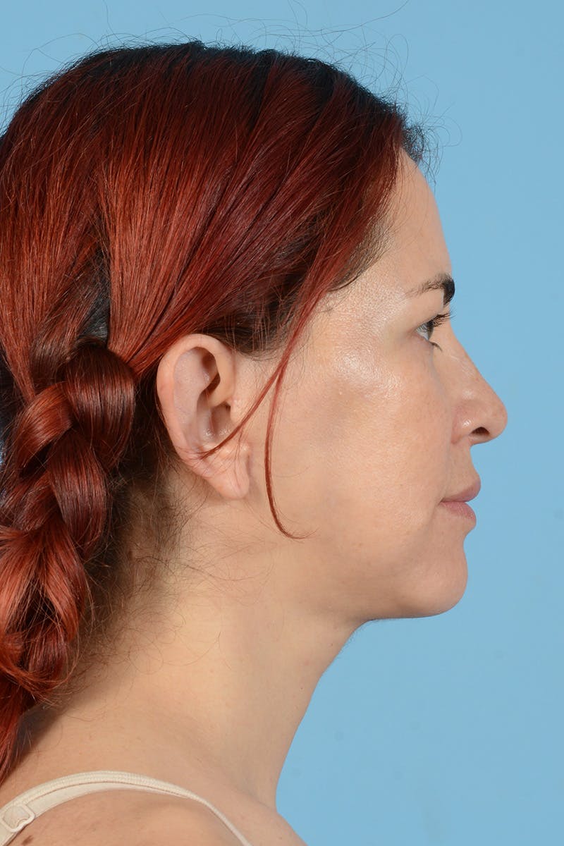 Neck Lift Before & After Gallery - Patient 126947 - Image 6