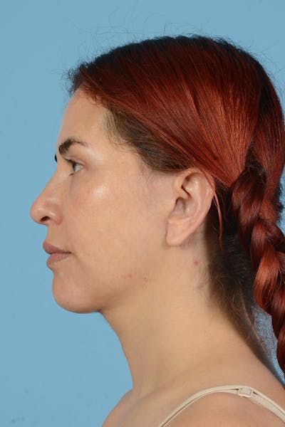 Neck Lift Before & After Gallery - Patient 126947 - Image 10