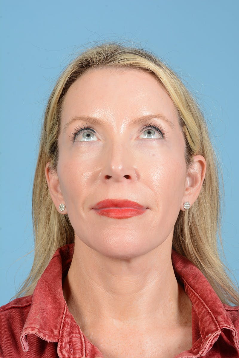 Facelift Before & After Gallery - Patient 694453 - Image 6