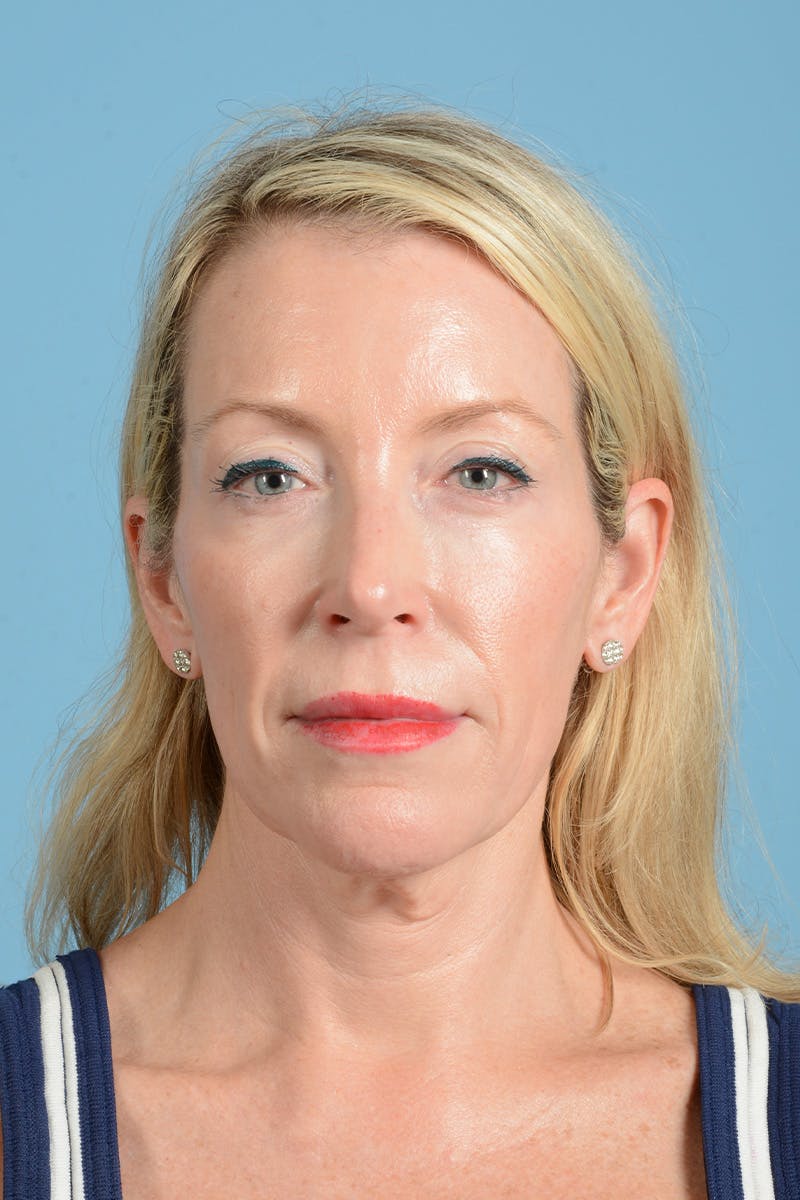 Facelift Before & After Gallery - Patient 694453 - Image 1