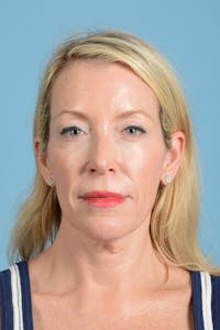 Facelift Before & After Gallery - Patient 694453 - Image 1