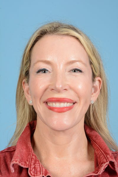 Facelift Before & After Gallery - Patient 694453 - Image 4