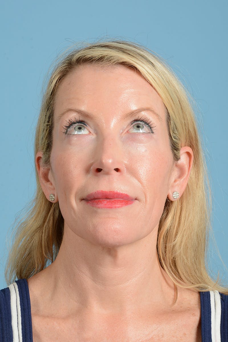 Facelift Before & After Gallery - Patient 694453 - Image 5