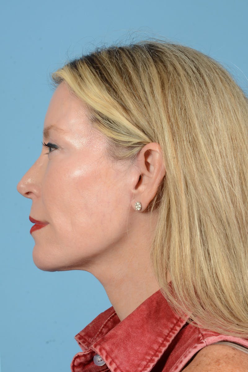 Facelift Before & After Gallery - Patient 694453 - Image 16
