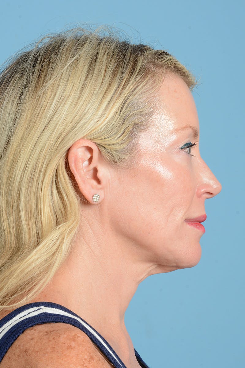 Facelift Before & After Gallery - Patient 694453 - Image 11