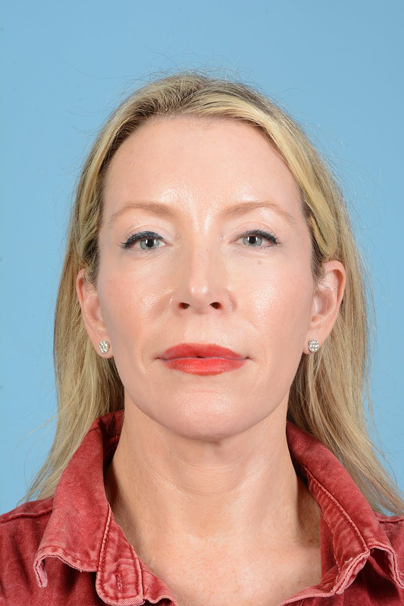 Facelift Before & After Gallery - Patient 694453 - Image 2