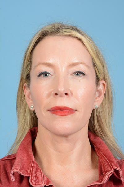 Facelift Before & After Gallery - Patient 694453 - Image 2