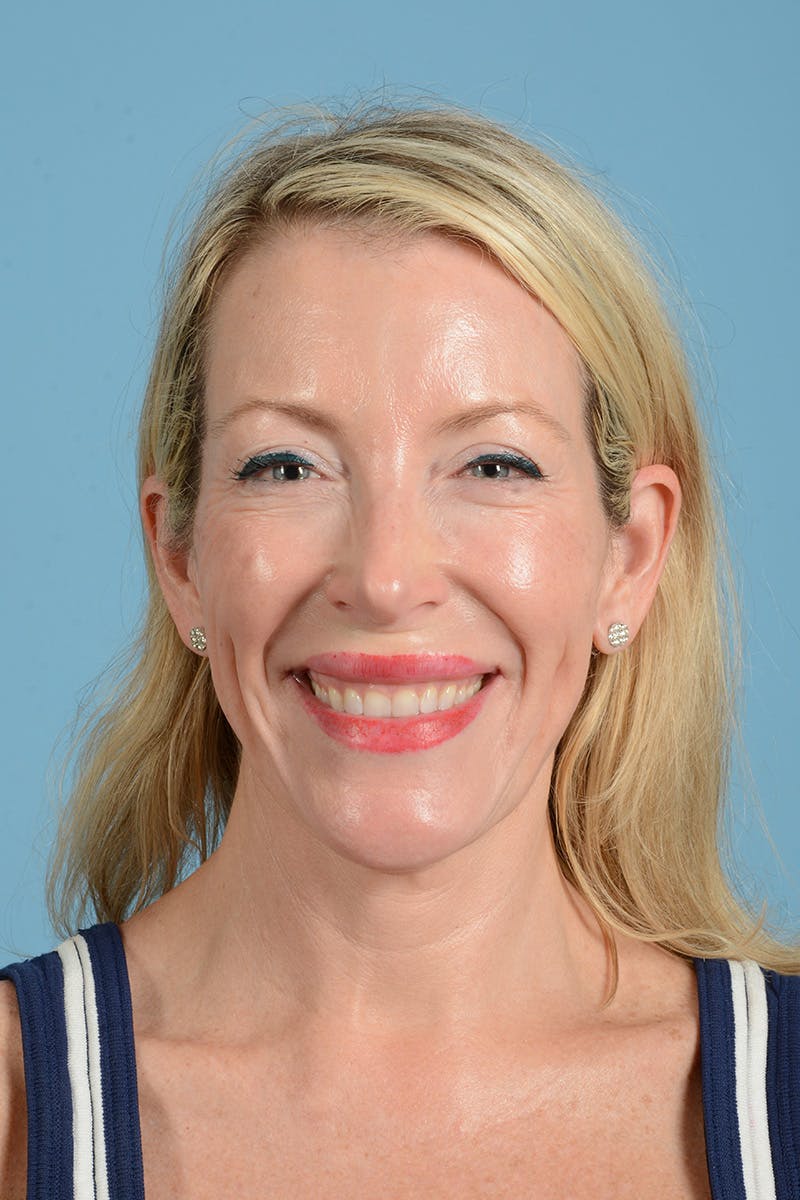 Facelift Before & After Gallery - Patient 694453 - Image 3